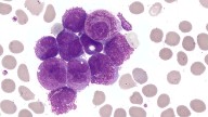 High-Risk APL: Targeted Therapy Outshines Chemo