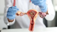 Missed Opportunities to Prevent Ovarian Cancer During Unrelated Surgeries