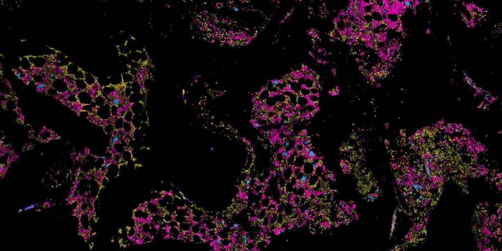 Un mapa molecular de la médula ósea abre la puerta a terapias más efectivas contra el mieloma múltiple