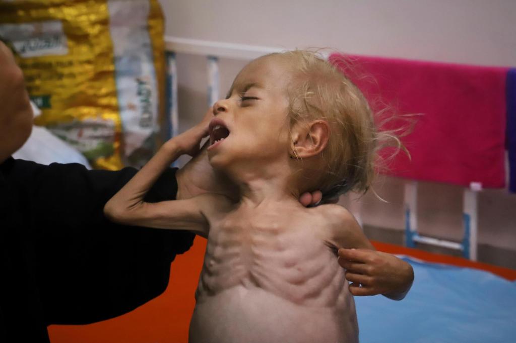 Malnourished kids arrive daily at a Gaza hospital as hunger grows