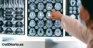 Un megaestudio muestra que los trastornos digestivos multiplican el riesgo de sufrir alzhéimer y párkinson