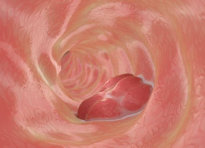 Colorectal Cancer Screening by Mailed Testing Kits Have Highest Participation