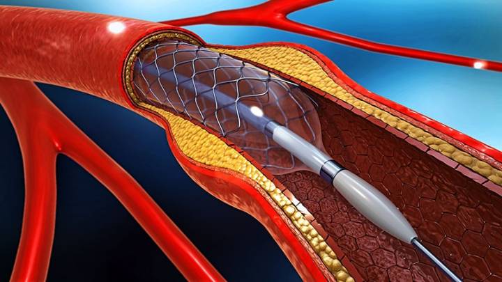 Paclitaxel Balloon Improves Complex Stent Care