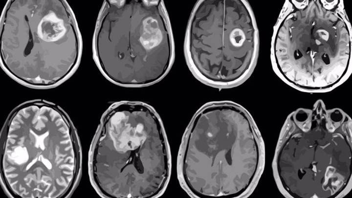 Cuando el cáncer afecta al cerebro: primeros síntomas de alerta, tratamientos y esperanza de vida
