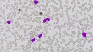 Leukemia Relapse: PD-1 Inhibition Shows Mixed Results