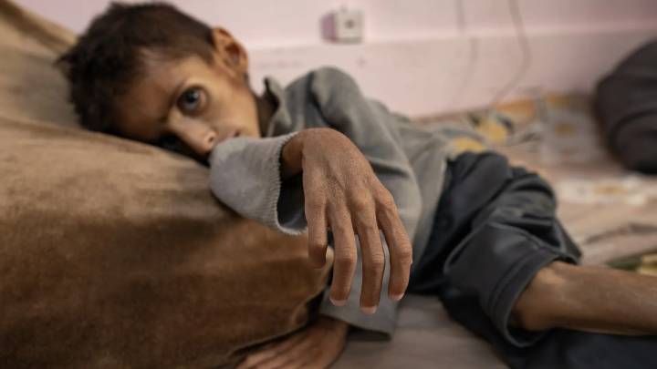 La desnutrición infantil se triplica desde marzo en la Franja de Gaza, según la ONU
