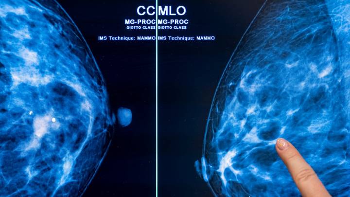 Study reveals how fat cells can fuel breast cancer tumors