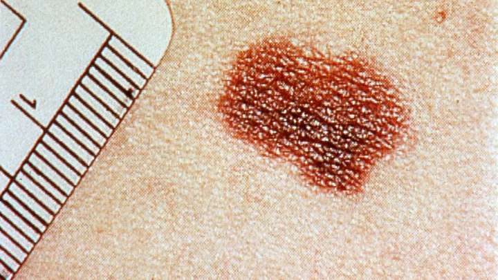 Descubren un "sistema GPS" del melanoma que podría frenar la metástasis
