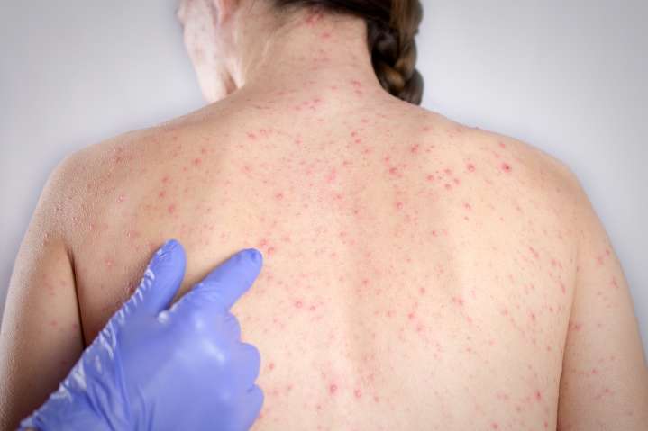 Alerta en Kentucky por más casos de sarampión