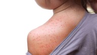 2 school-aged children in Washington County test positive for measles