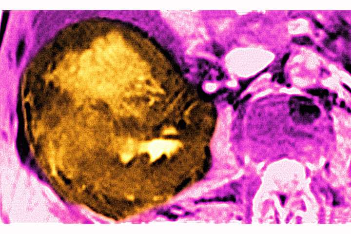 Liver Cancer Cases Are On The Rise. Here’s How To Avoid Getting It