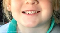 La comunidad científica desmiente que las células madre de dientes de leche puedan "curar" la diabetes o el autismo