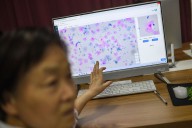 AI eroded doctors’ ability to spot cancer within months in study