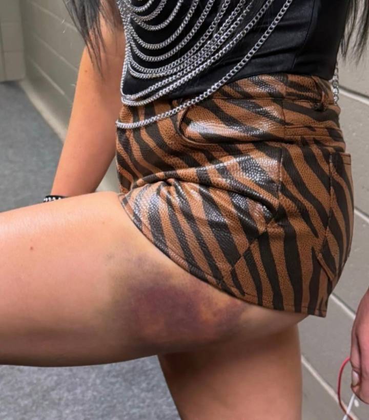 WWE Superstar Reveals Serious Bruise After Falling From Ladder