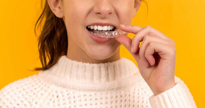 What I Wish I Had Known Before Getting Invisalign