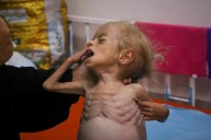 Malnourished kids arrive daily at a Gaza hospital as hunger grows