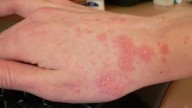 Especialista de la UAS alerta sobre contagio de escabiosis por ropa usada sin desinfectar