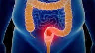 Un reciente estudio indica que las personas que padecen trastornos intestinales tienen el doble de probabilidades de desarrollar Alzheimer.