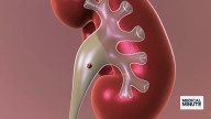 Why are kidney stones increasing in children and teens?