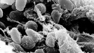 First Confirmed Human Plague Case In California In 5 Years Likely From Flea Bite, Officials Say