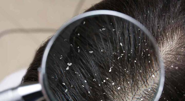 ¿Por qué sale caspa en el cabello? Causas y tratamientos