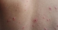 Wisconsin officials report potential measles exposure at 2 travel stops
