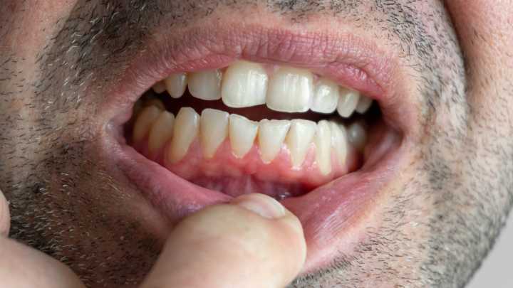 El sangrado de encías no es normal: «Nos debería preocupar igual que si nos sangra un ojo o un oído»