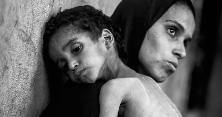 Hunger in Gaza: What Starvation Does to a Child’s Body