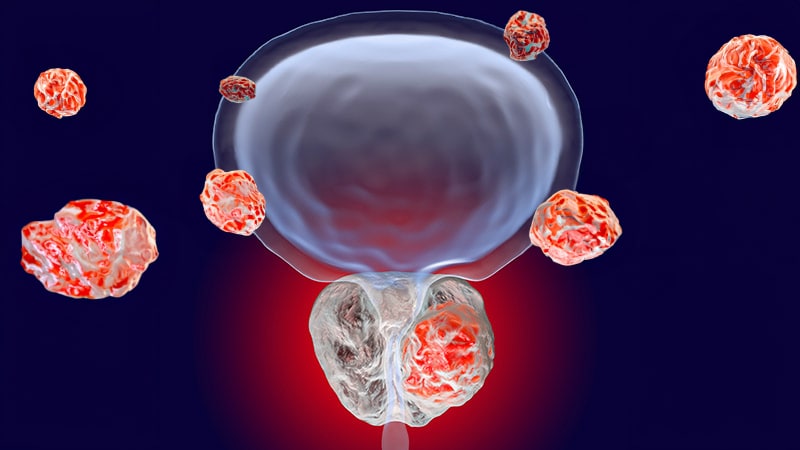 Don’t Reclassify Grade Group 1 Prostate Cancer: New Data