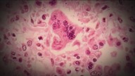 Idaho confirms third measles case