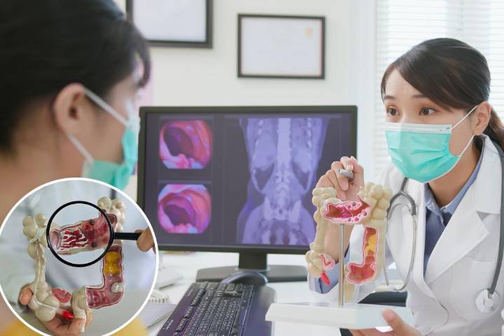 Key habit ups colorectal cancer survival odds — as docs see 'tremendous increase' in young patients
