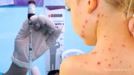 Coahuila suma ya 47 casos de sarampión; se mantiene en el tercer lugar nacional en número de contagios