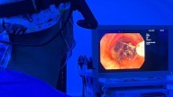 Una técnica pionera contra el cáncer de pulmón se aplica con éxito en el hospital Santa Lucía