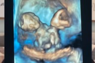 Mom Learns She's Having Conjoined Twin Girls—Given Two Devastating Choices