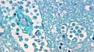 'Brain-eating amoeba' contracted in Missouri. What to know