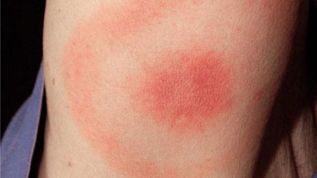 What happens when you get Lyme disease? What to look for