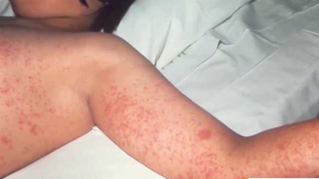 First Alabama measles case in 20 years pushes parents to do what they can to protect kids from virus