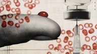 A new diabetes subtype is discovered
