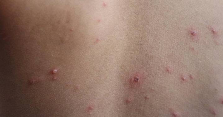 Wisconsin officials report potential measles exposure at 2 travel stops