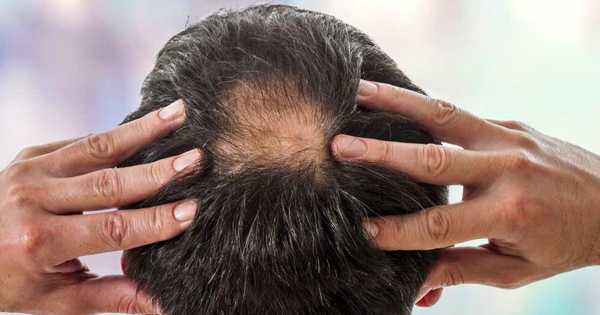 La solución fácil y rápida para la calvicie: este es el remedio casero que ayuda a prevenir la caída del cabello