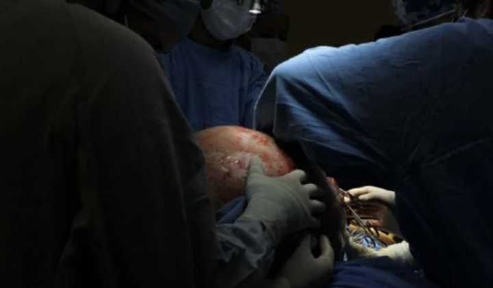 IMSS de Querétaro extirpa tumor ovárico de casi 23 kilogramos a paciente de 37 años