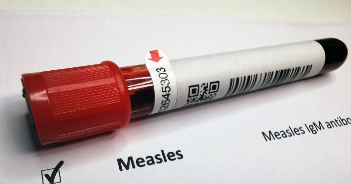 Spokane County resident presumed to have measles following exposure, symptoms
