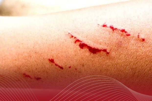 Fallece hombre en Colima por rabia humana
