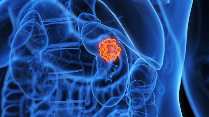Drug Combo Shows Benefits in Rare, Aggressive Kidney Cancer