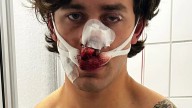 US model beaten to a pulp and left disfigured while defending woman from ‘drug dealing illegal migrant’ on German tram