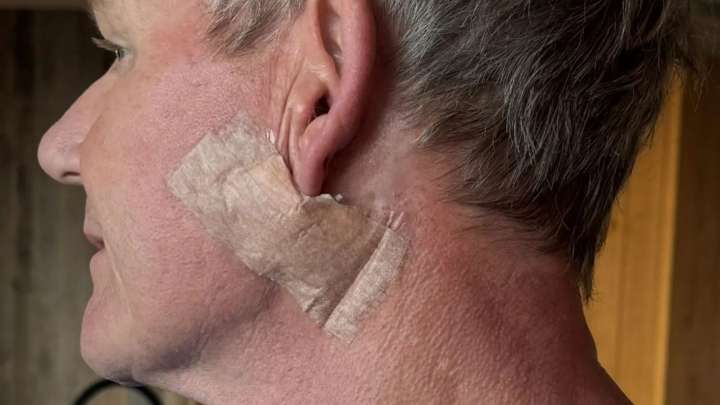 Gordon Ramsay reveals he's had operation to remove skin cancer from his face as he warns fans to wear sunscreen