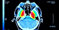 Japan’s Pharma Leader Is Seeking Approval for a New Parkinson’s Treatment