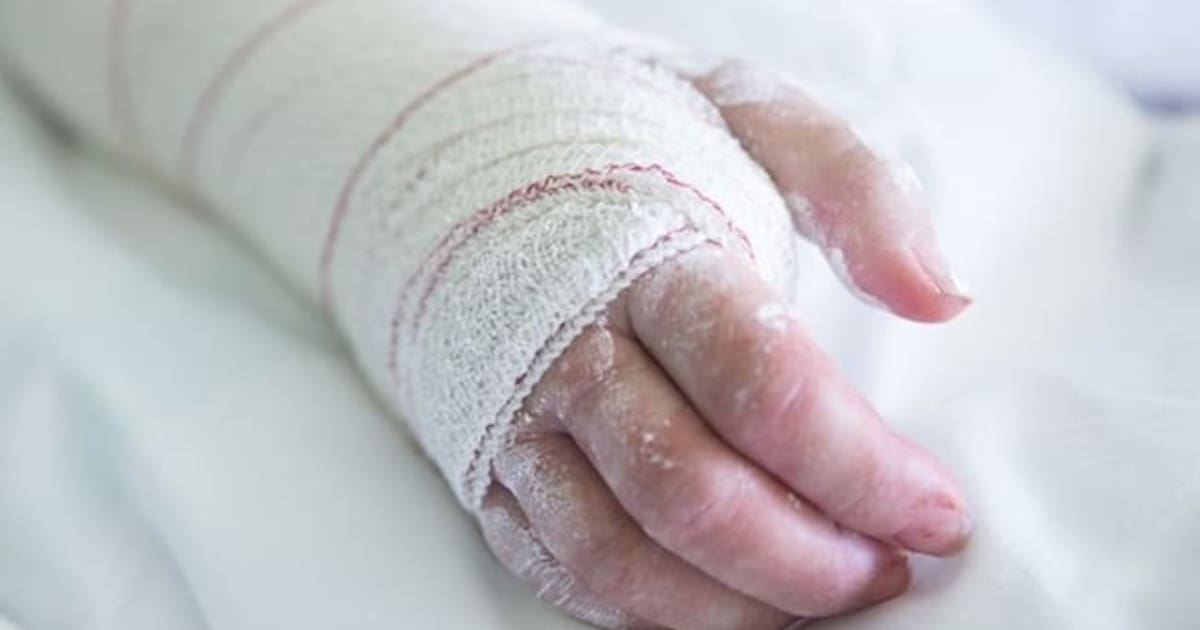 Este es el parte médico de la pareja quemada en aparente ataque de celos en Gamarra, Cesar