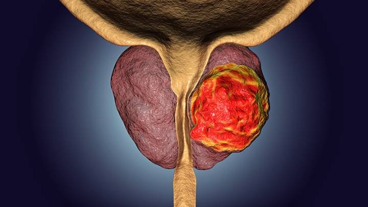 Focal Radiation Boost Enhances Prostate Cancer Control