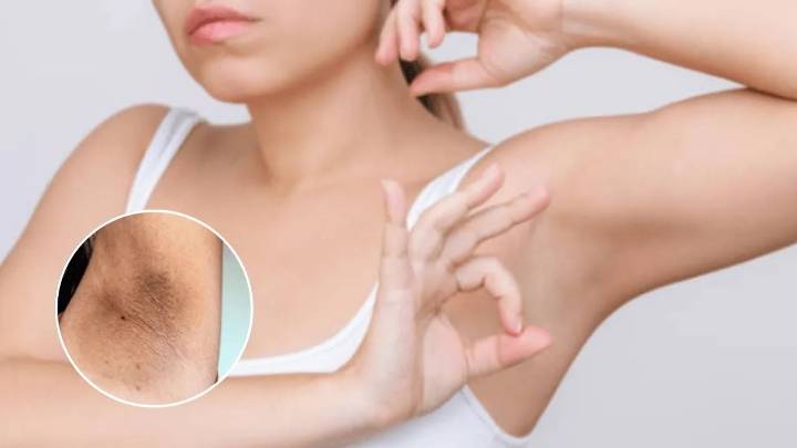 Axilas oscuras: el 'secreto' detrás de blanquearlas podría estar en tu botiquín